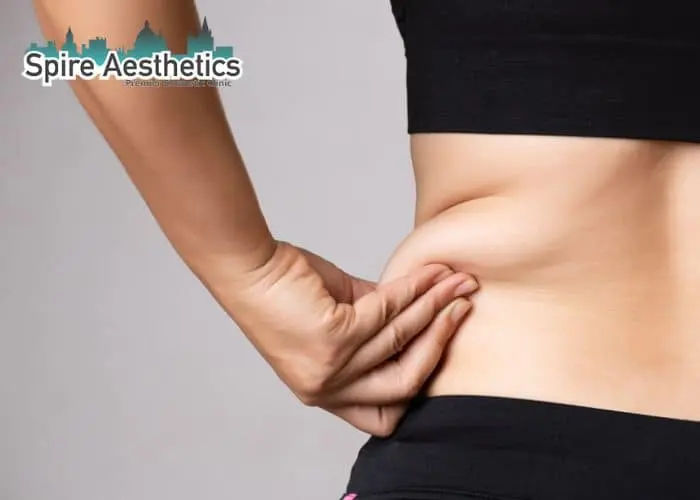 Image of woman pinching fat on their hips Peak Dale. Fat Freezing treatment