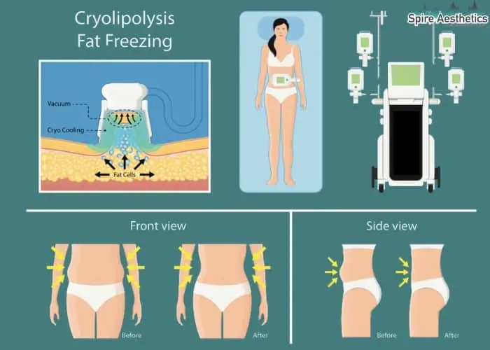 Fat freezing treatment Peak Dale benefits for competitions to remove stubborn fat deposits.
