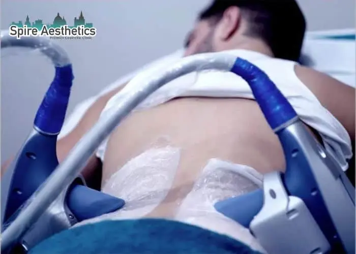 Man having fat freezing treatment done on love handles before a competitions Peak Dale to create a sculpted look.