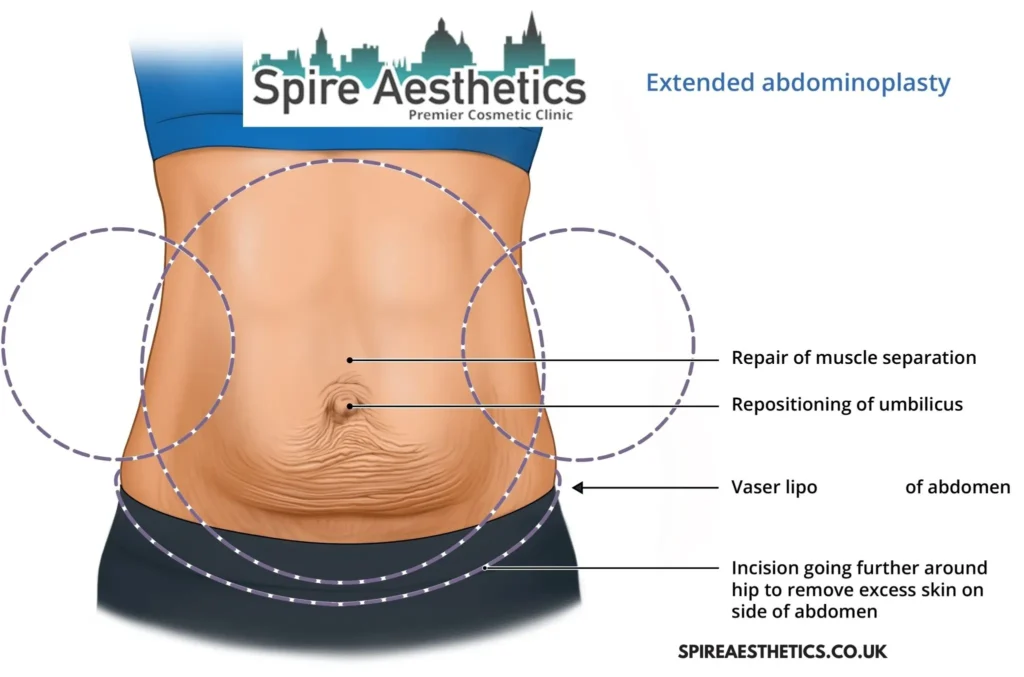 Understanding Loose Skin After Gastric Band Peak Dale Surgery and HIFU Treatment