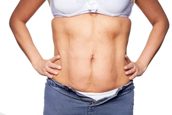 sagging skin on woman's stomach after weight loss injections Peak Dale