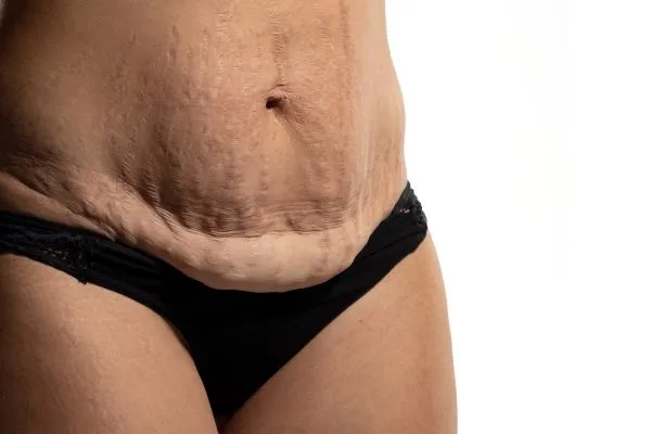 Image of womans stomach after weight loss injections Peak Dale showing saggy skin