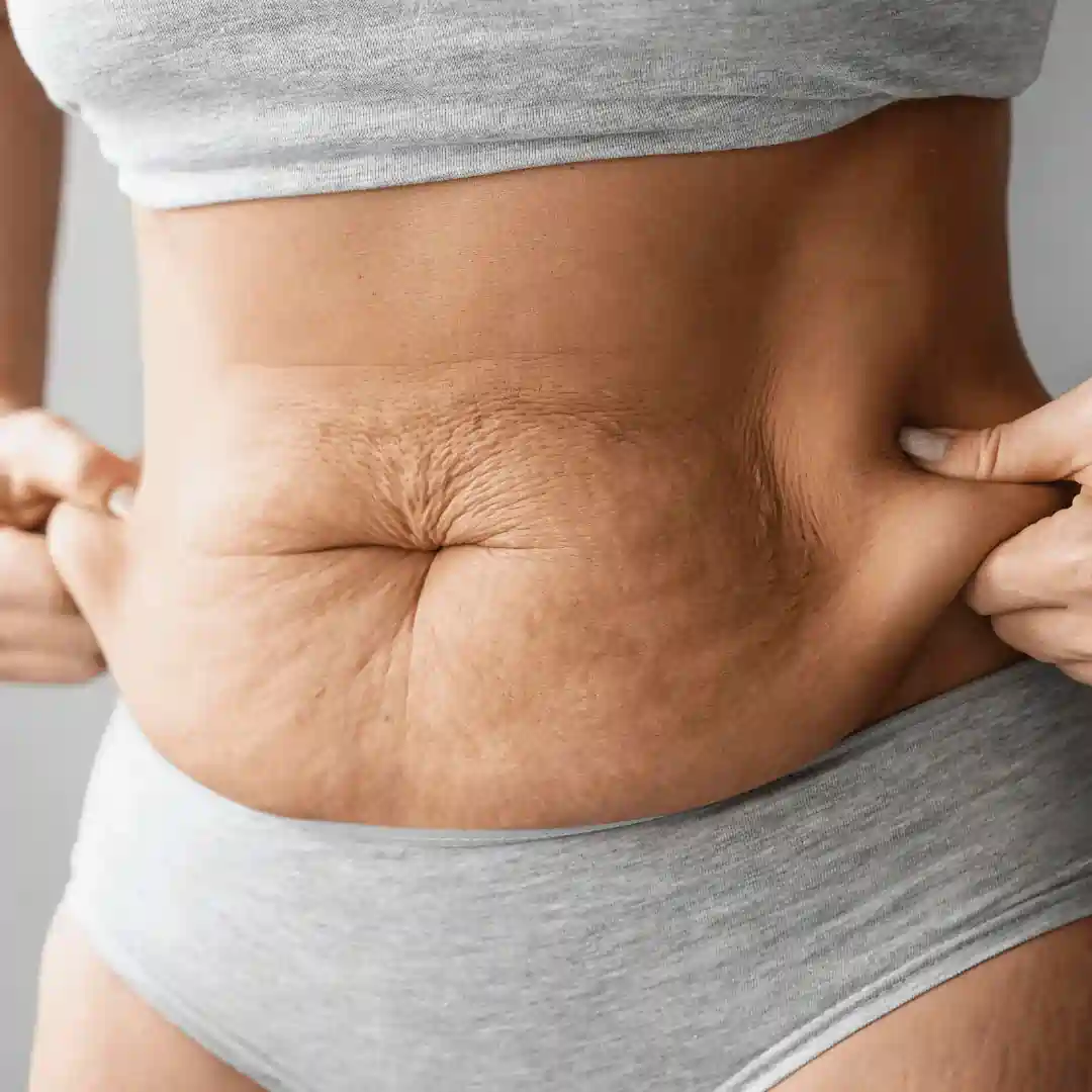 Is It Normal to Have Loose Skin After Pregnancy Peak Dale?